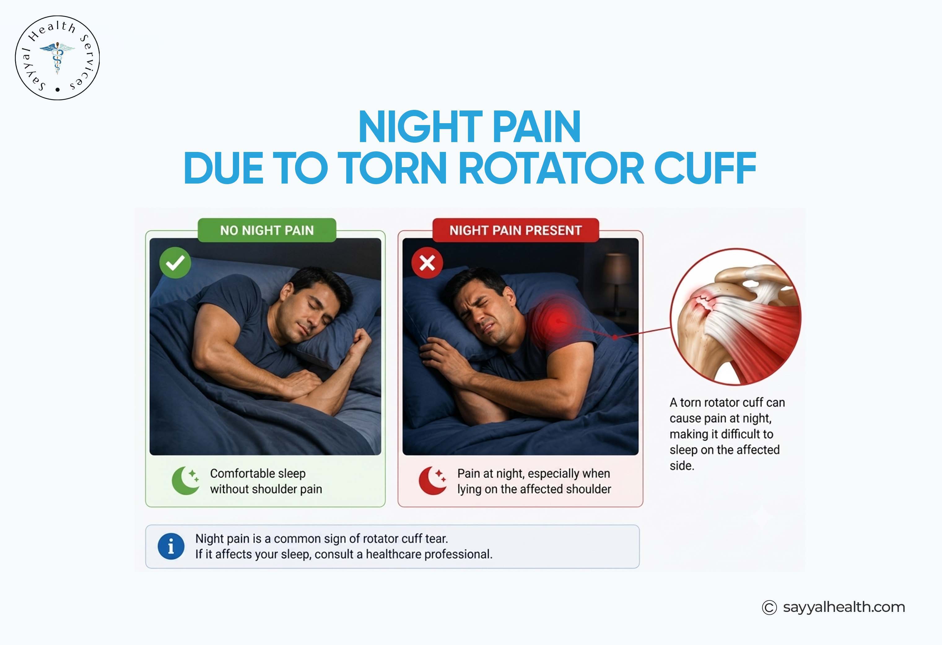 night pain due to torn rotator cuff